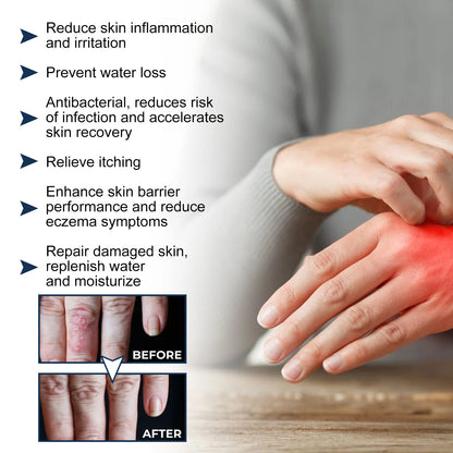 South Moon Calfskin Soothing Psoriasis Relief Spray – Effective Itch, Redness & Skin Repair (30ml)