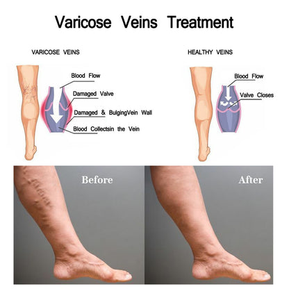 JAYSUNG Varicose Vein Cream – Advanced Relief for Leg Pain, Swelling & Spider Veins